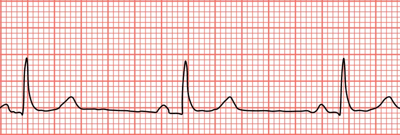 dailybiojuan-bradycardia-visual-1